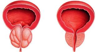 разликата болни и здрави простатата